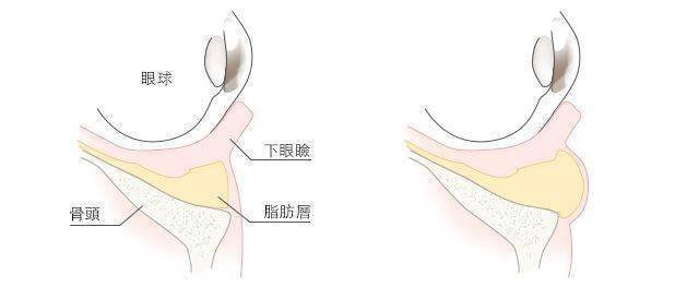 極緻醫美 眼袋 淚溝 眼袋手術 老化 眼袋內開眼袋外開