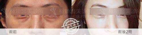 眼袋 淚溝 極緻醫美 余德毅醫師