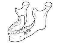 勒福式第一型上颚切骨手术(le forti i osteotomy)