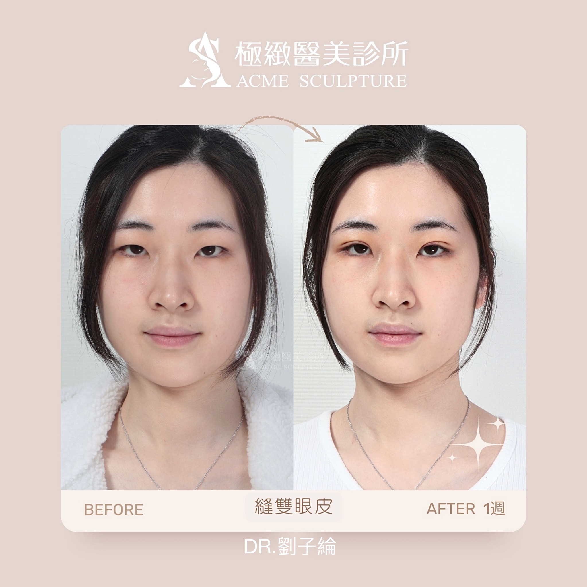 縫雙眼皮 劉子綸醫師 