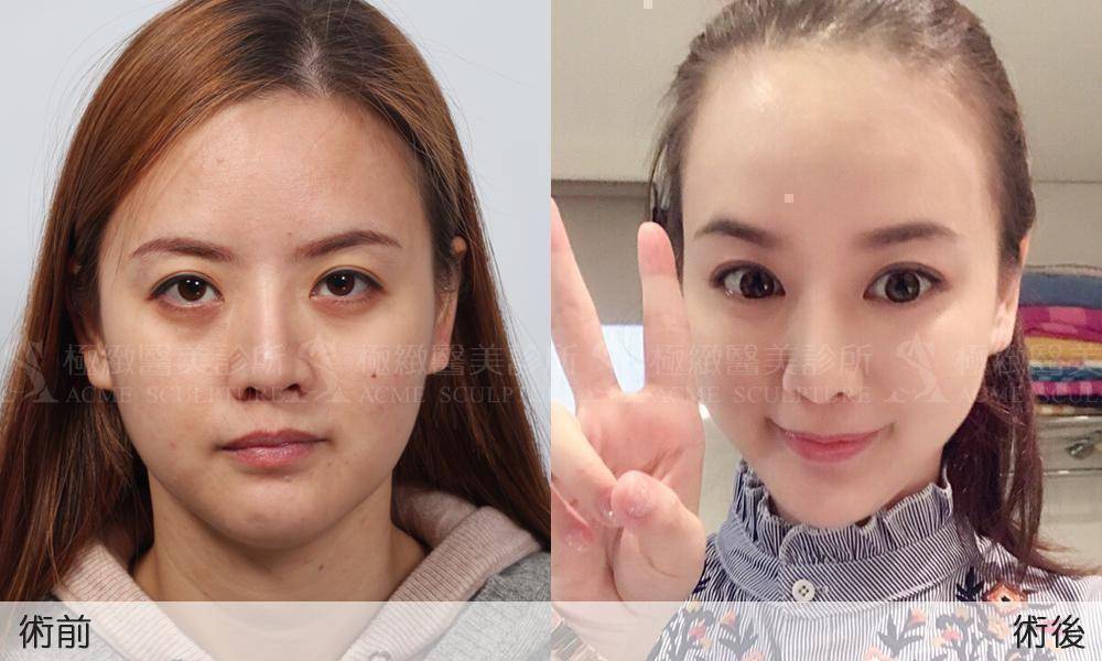 微創提眉手術提眉提眉手術內視鏡微創提眉前額拉皮極緻醫美雙眼皮雙眼皮手術