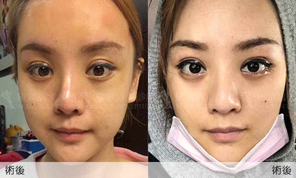 微創提眉手術提眉提眉手術內視鏡微創提眉前額拉皮極緻醫美荊偉政雙眼皮雙眼皮手術03.jpg 微創提眉手術提眉提眉手術內視鏡微創提眉前額拉皮極緻醫美雙眼皮雙眼皮手術
