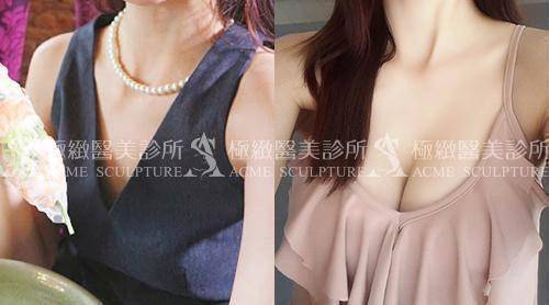 極緻醫美果凍隆乳案例1