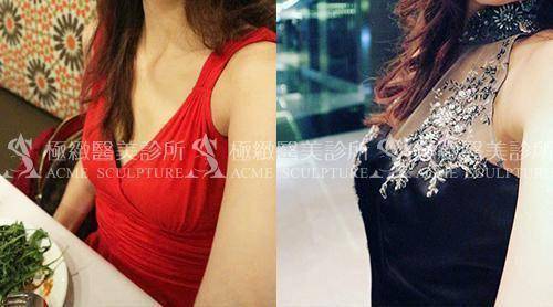 極緻醫美果凍隆乳案例2