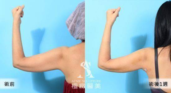 手臂抽脂案例3