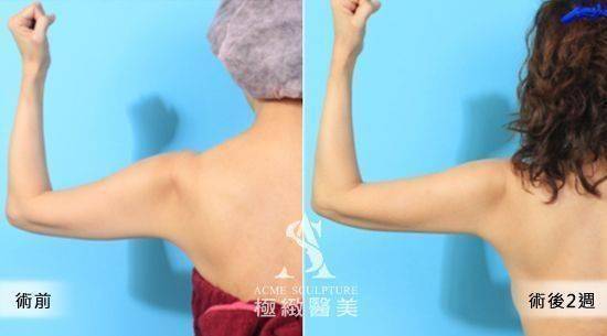 手臂抽脂案例2-3