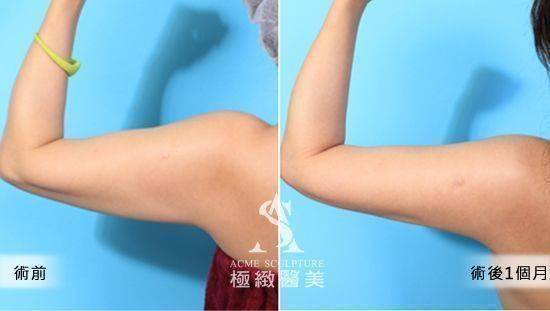 手臂抽脂案例4