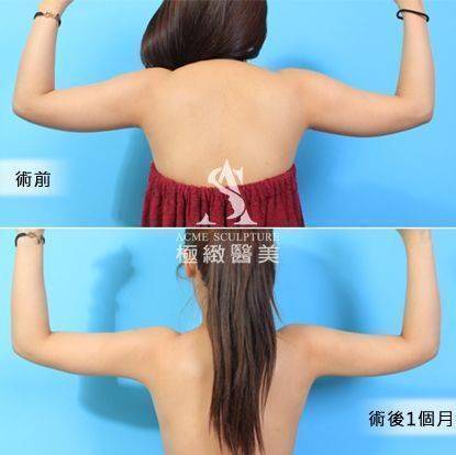 手臂抽脂案例6