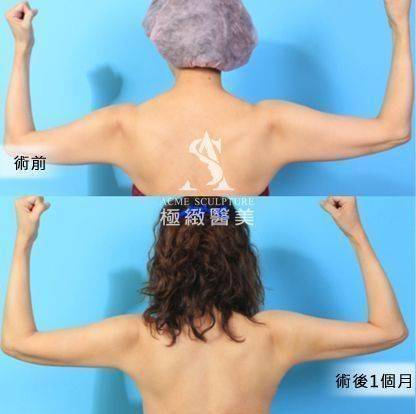手臂抽脂案例7