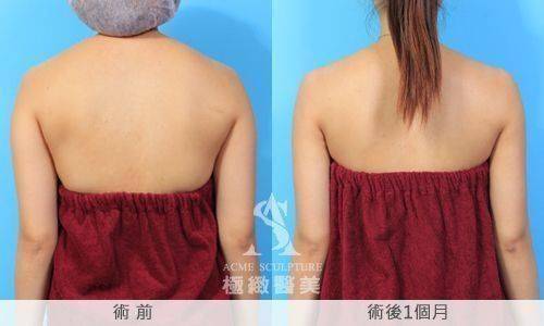 手臂抽脂案例2