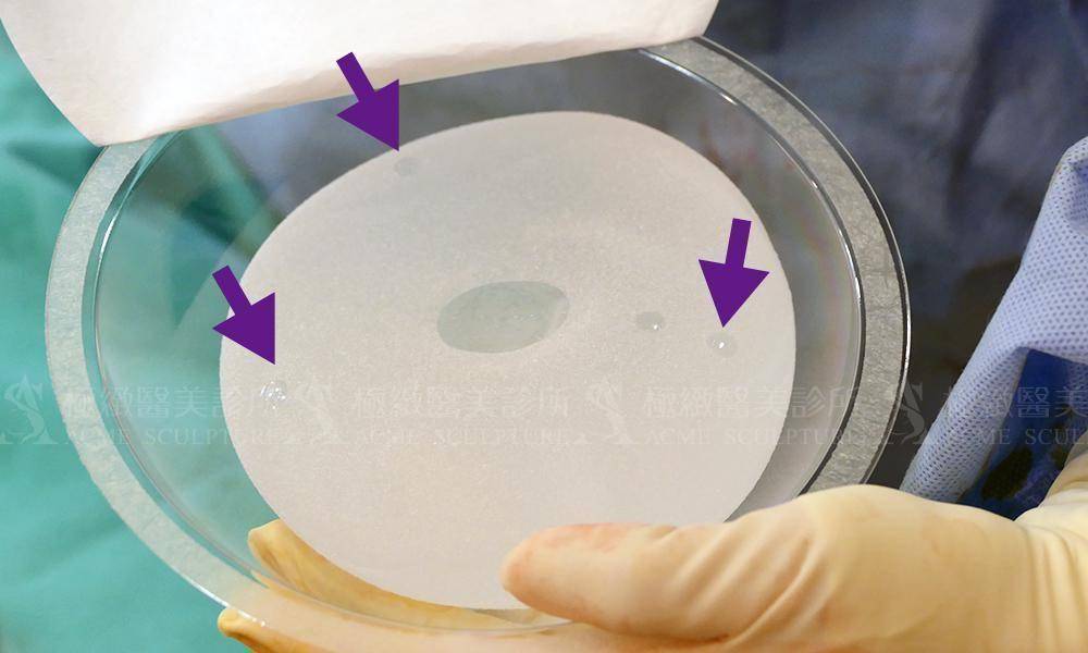 果凍矽膠隆乳材質提供了更精準的定位點-極緻醫美