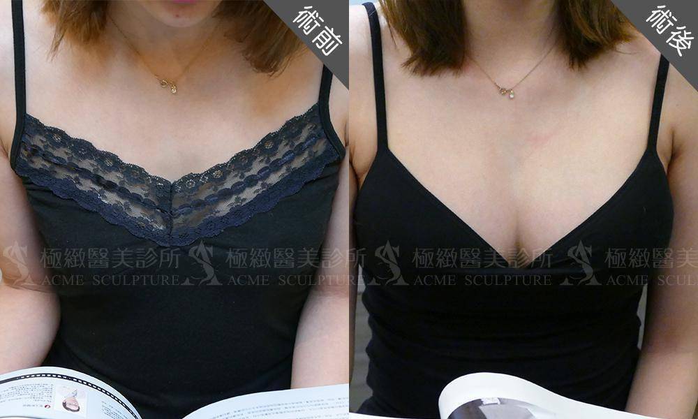 果凍矽膠隆乳塑造水滴狀美胸-極緻醫美