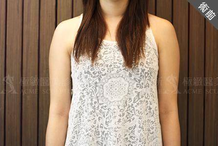 擺脫麵包手臂可考慮手臂抽脂