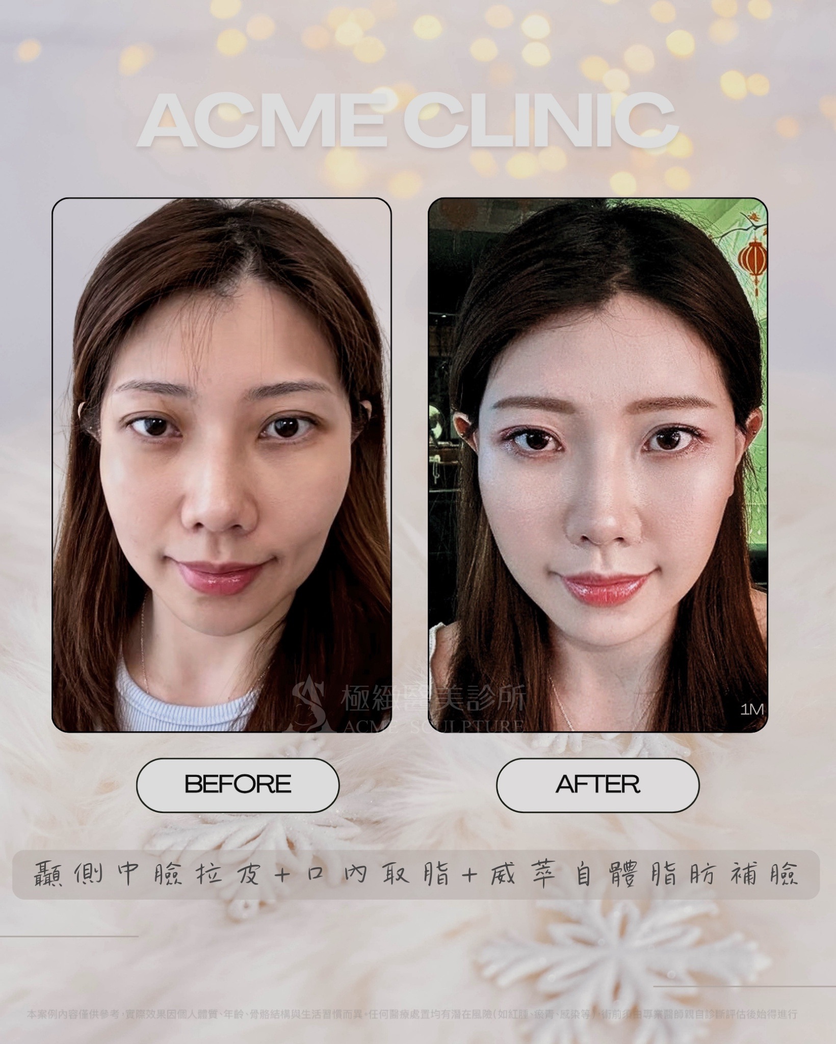 術前術後對比1