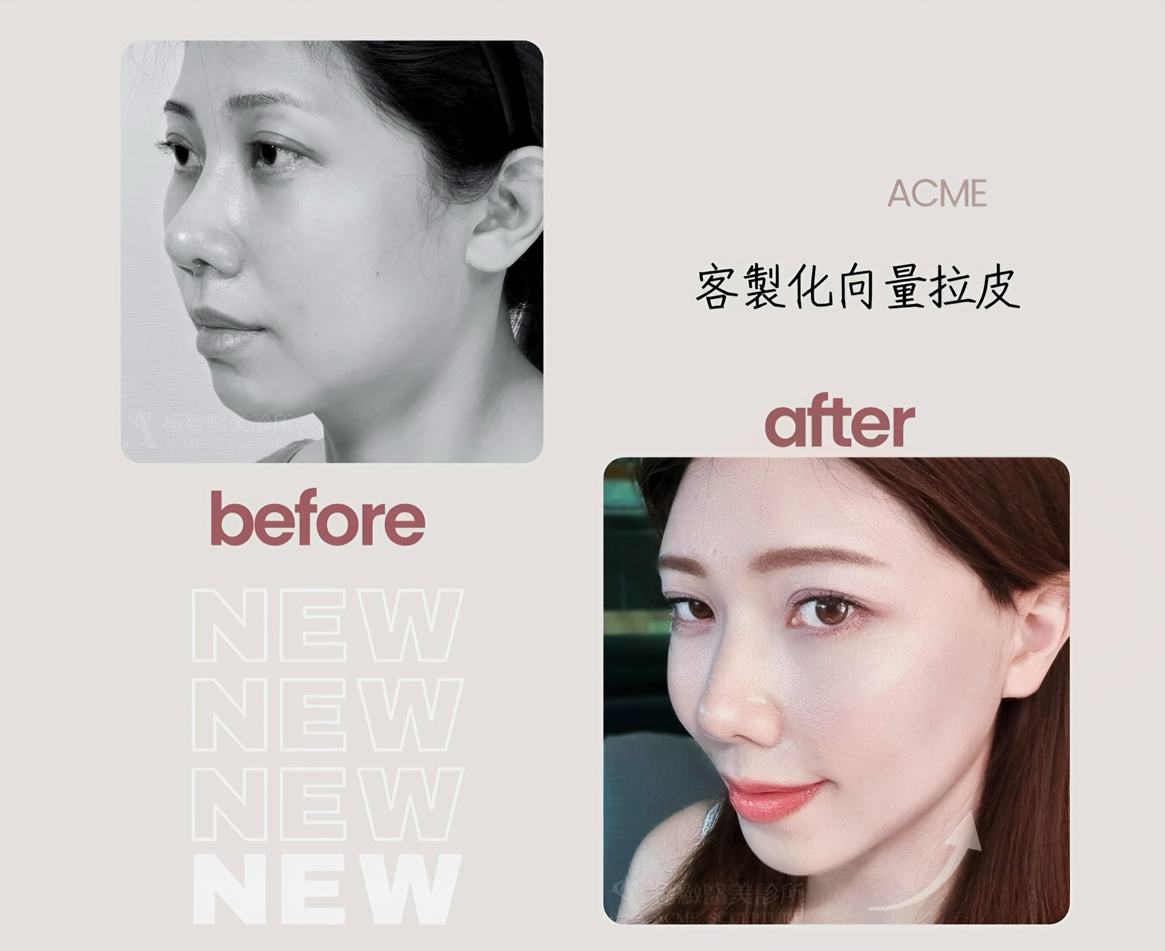 減重後臉鬆 顳側中臉拉皮術前術後 midface lift before after