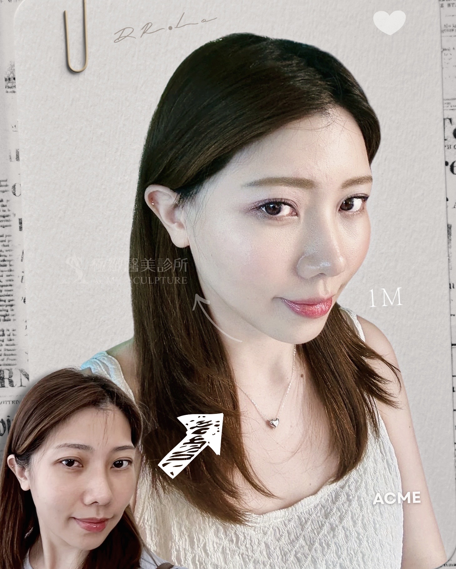 減重後臉垮 顳側中臉拉皮術前術後 midface lift before after