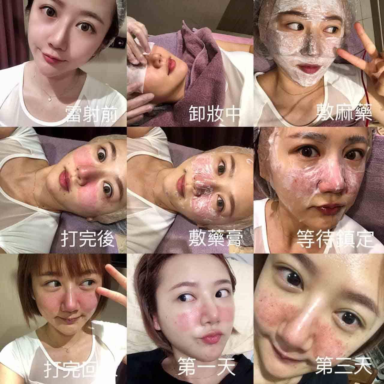 美容雷射新選擇 皮秒雷射picocare