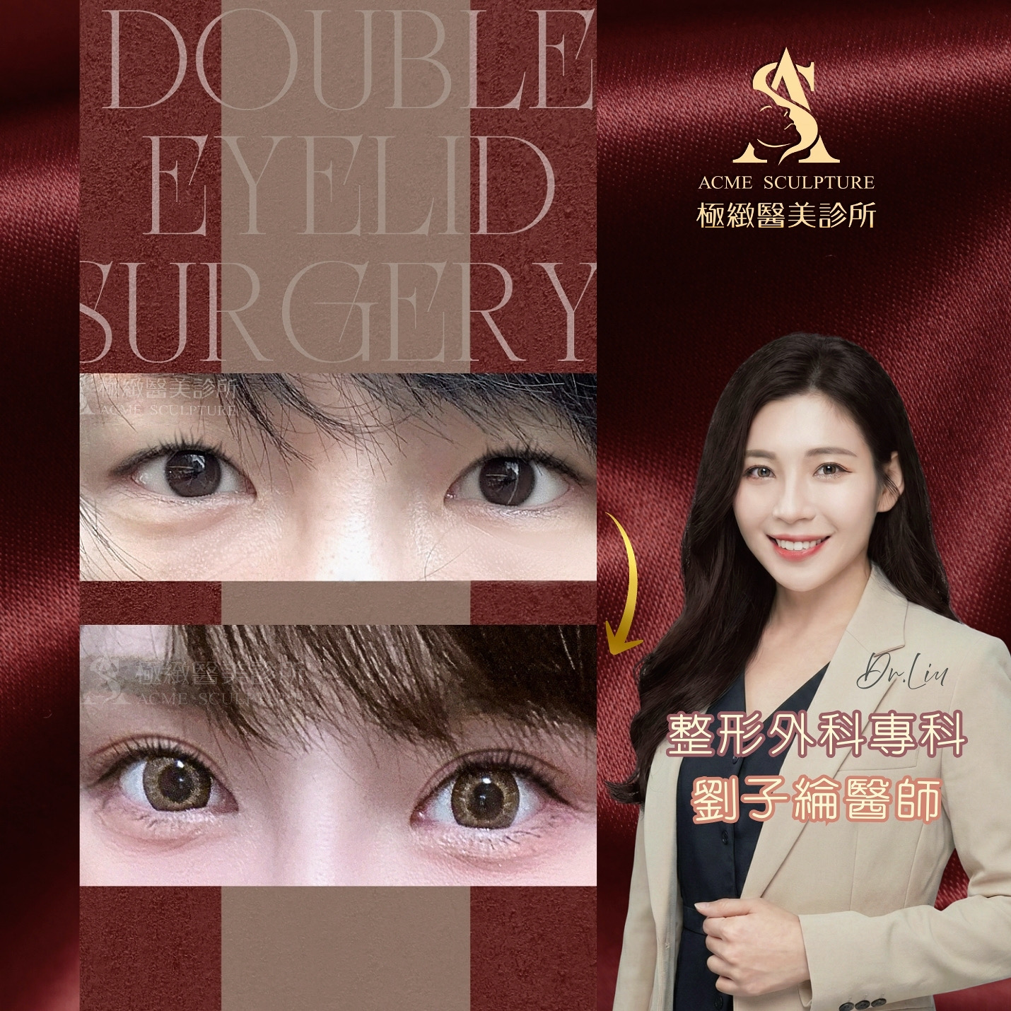 韓系雙眼皮術前術後紀錄-整形外科女醫師操作
