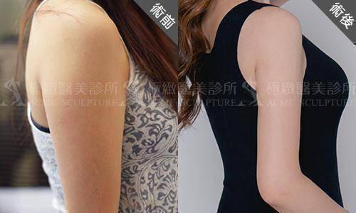 手臂抽脂效果驚人,別忘了術後兩週多做伸展運動