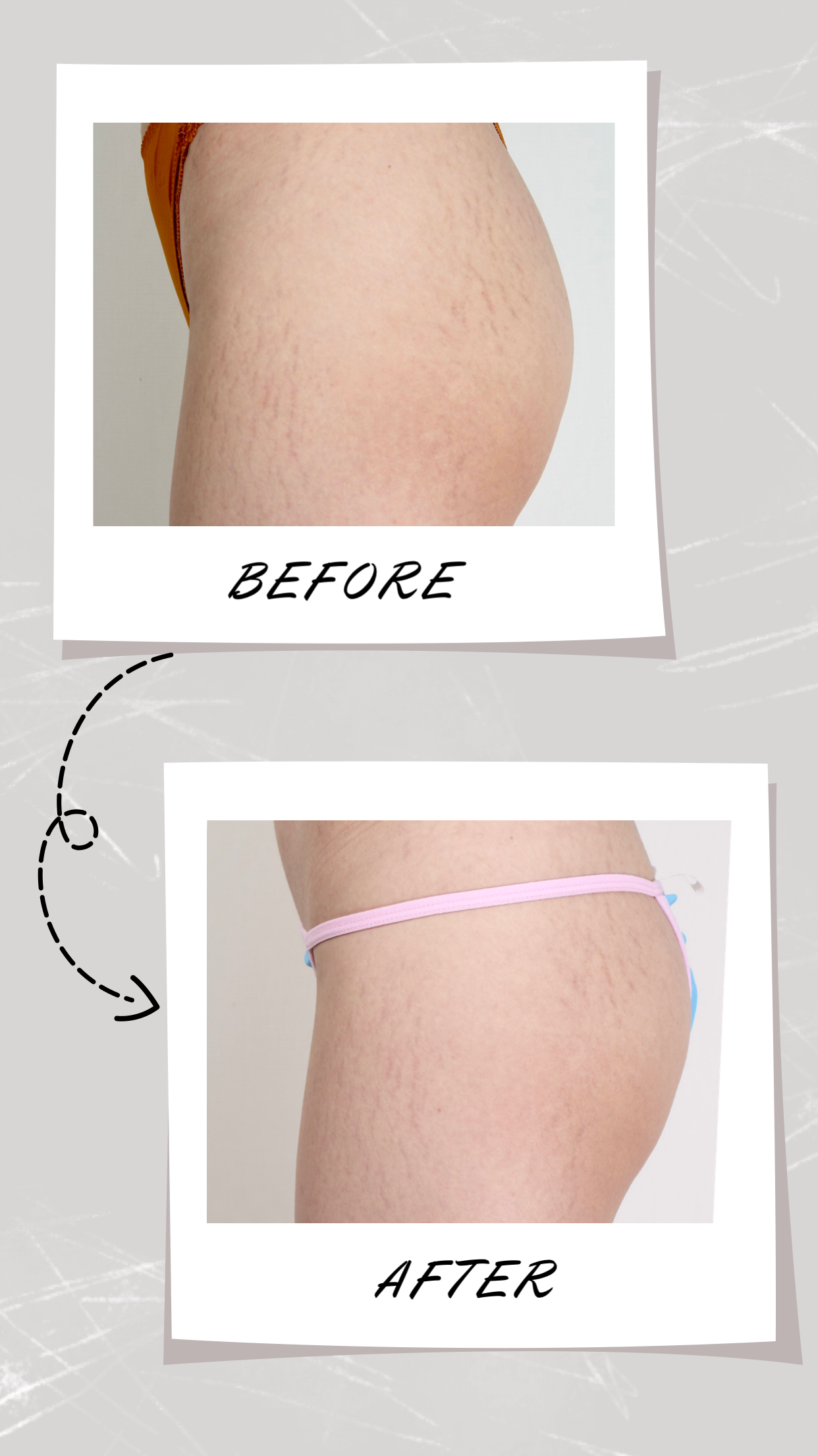 妊娠紋改善,肥胖紋,凹疤,大腿紋路,肚子紋路,懷孕紋