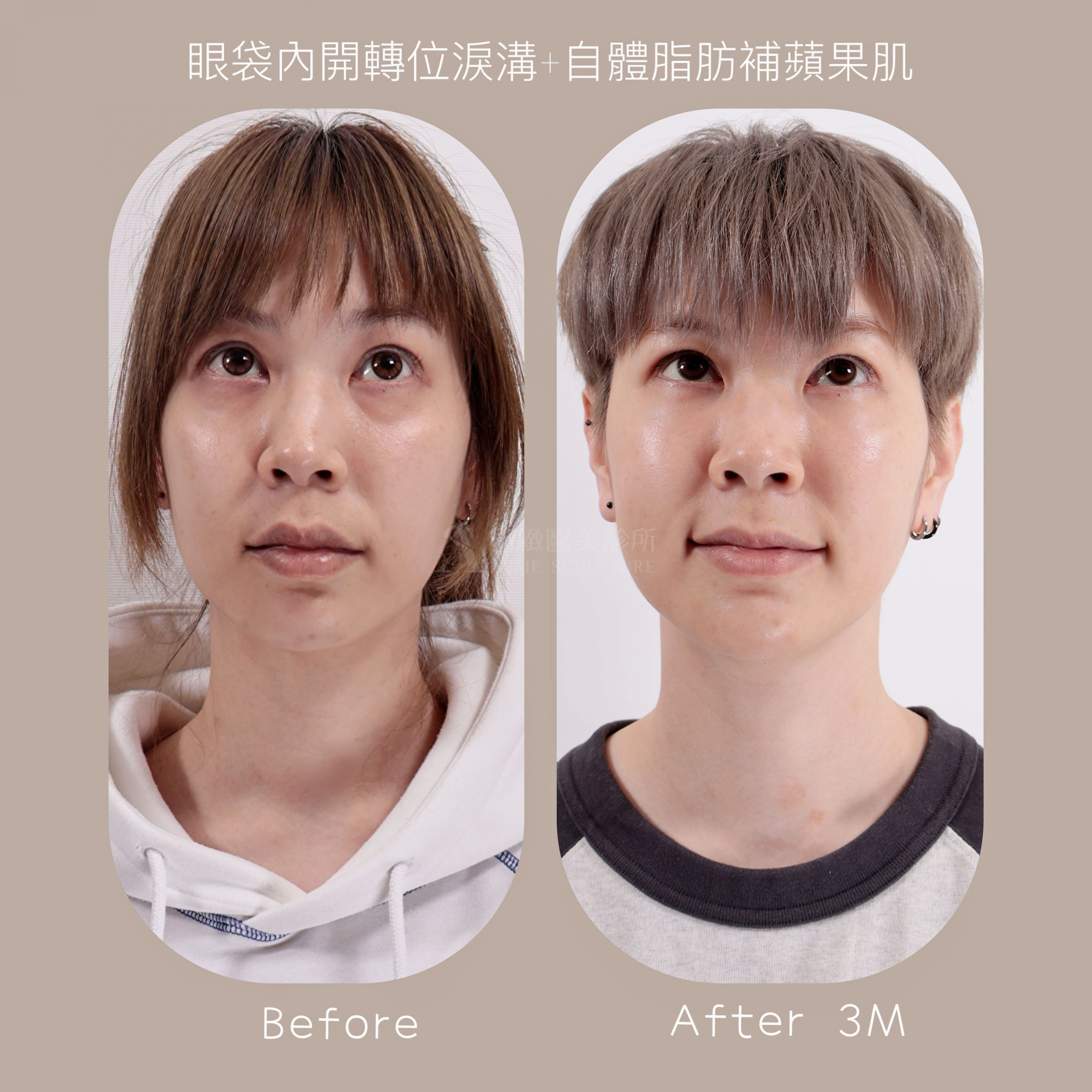 眼袋內開轉位淚溝+補脂 杜隆成醫師