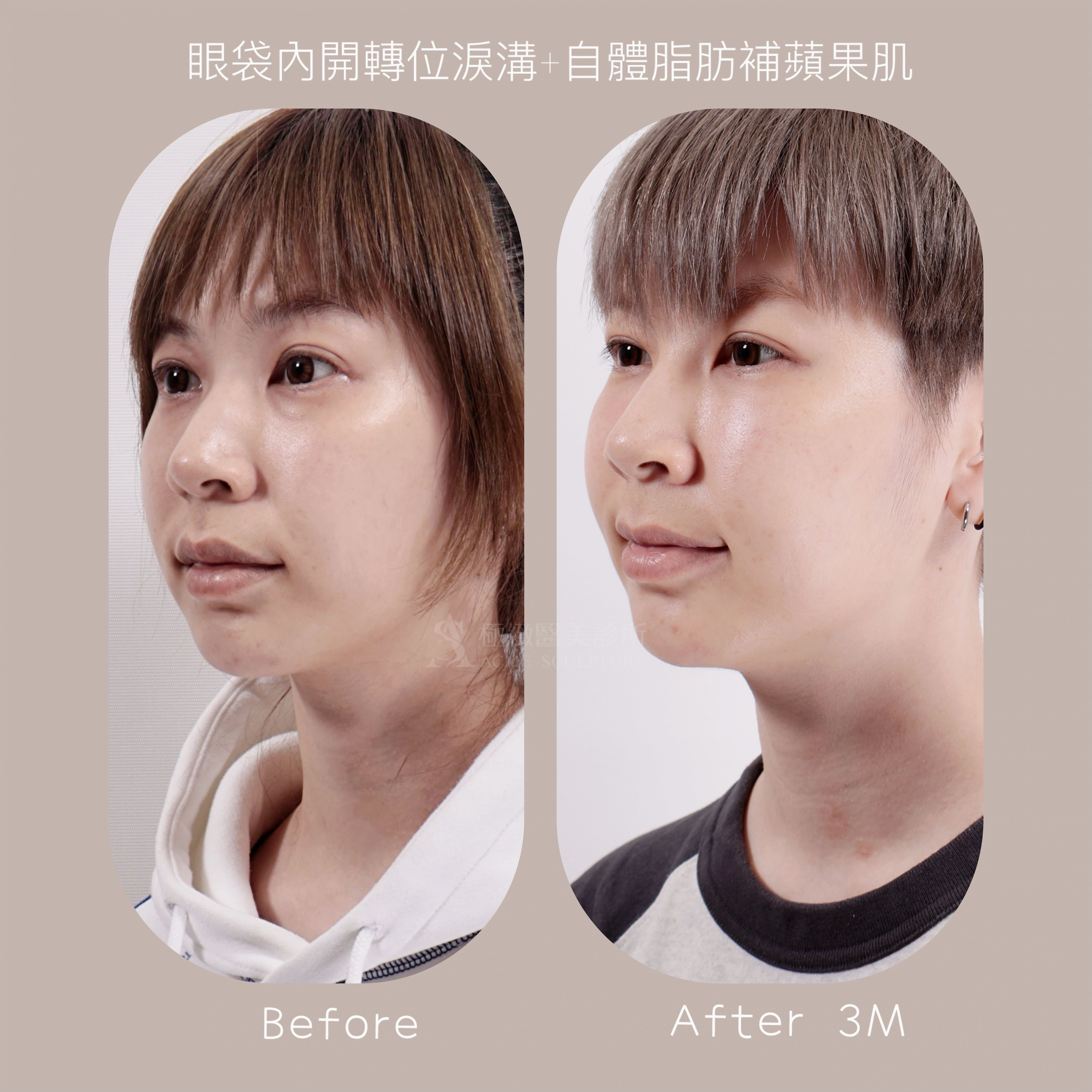 內開眼袋轉位淚溝 杜隆成醫師