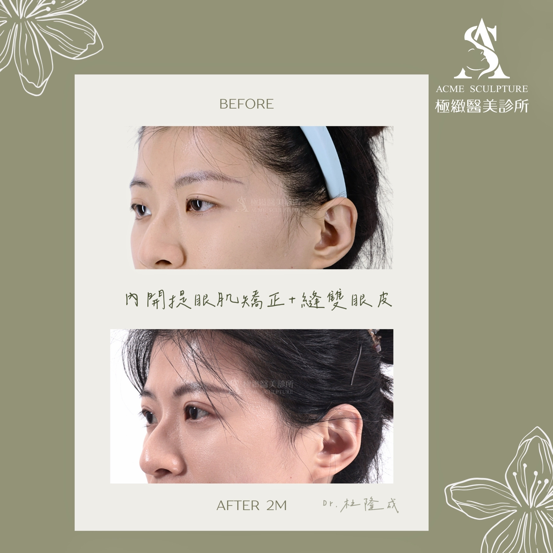 提眼肌矯正 杜隆成醫師