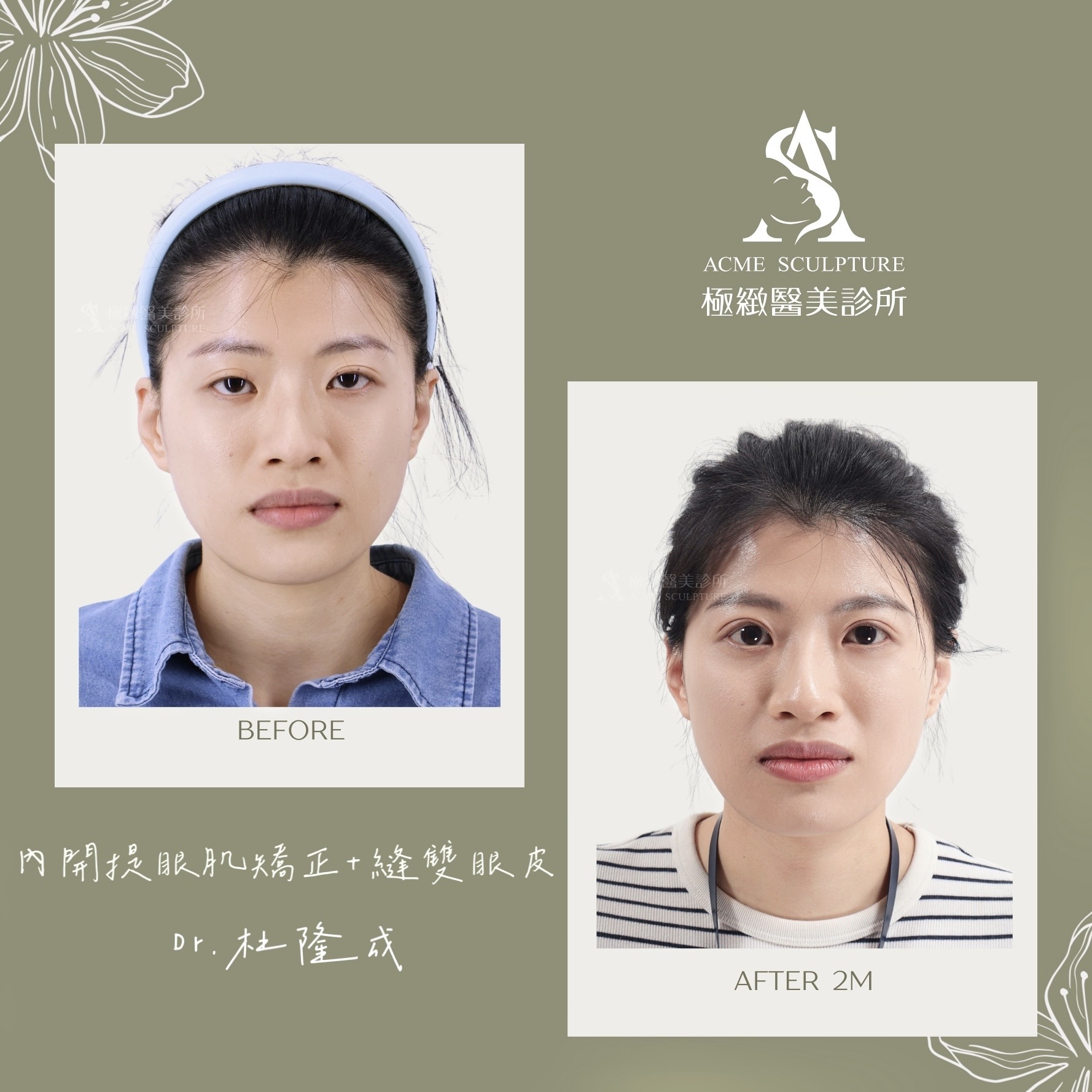 提眼肌矯正 雙眼皮