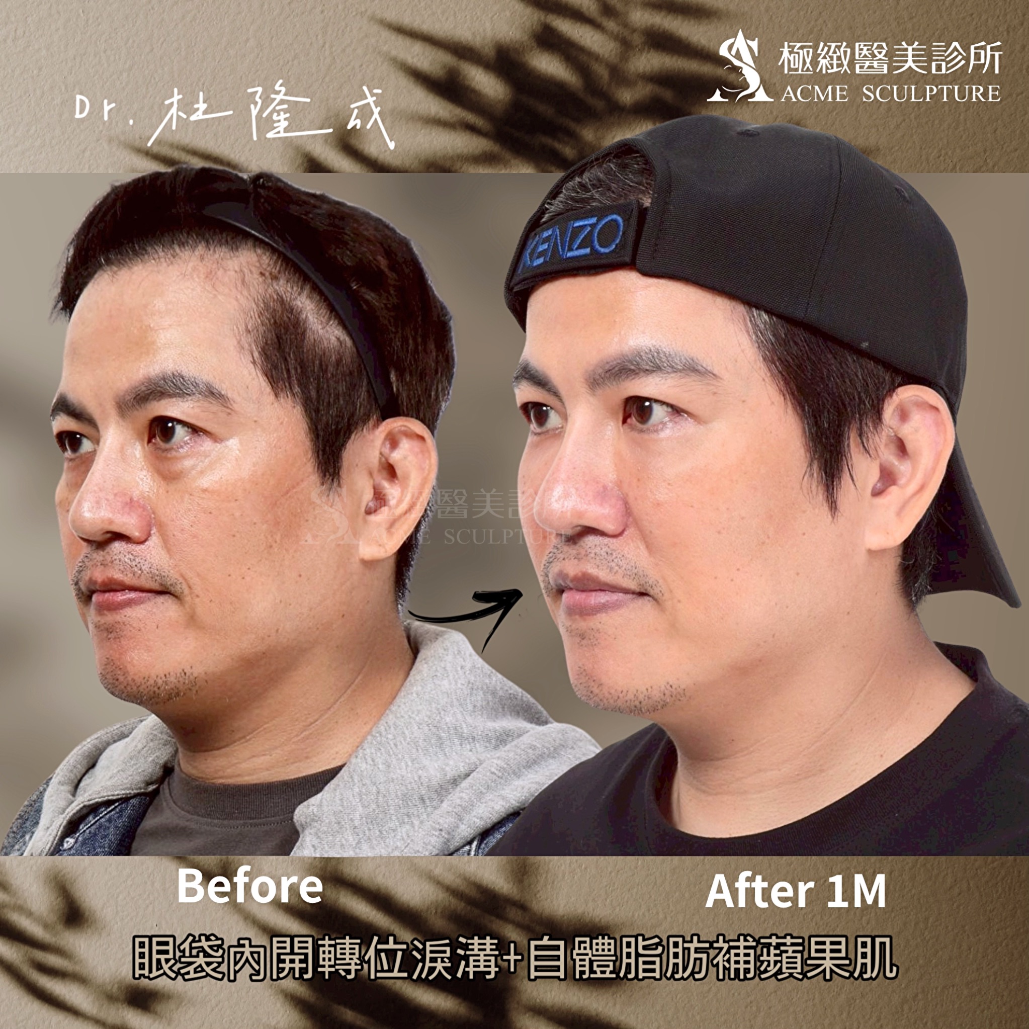 眼袋內開 臉部補脂 杜隆成醫師 台北眼袋