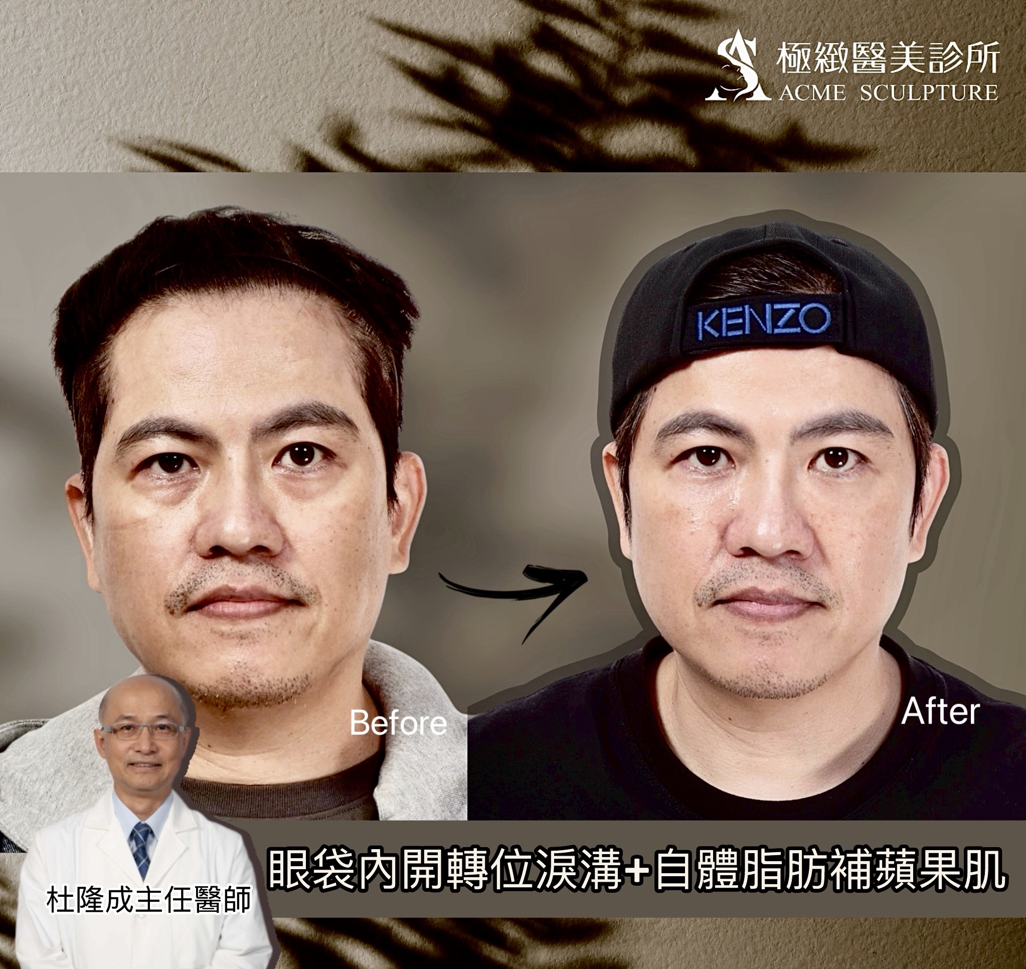 杜隆成醫師 內開眼袋 男性眼袋