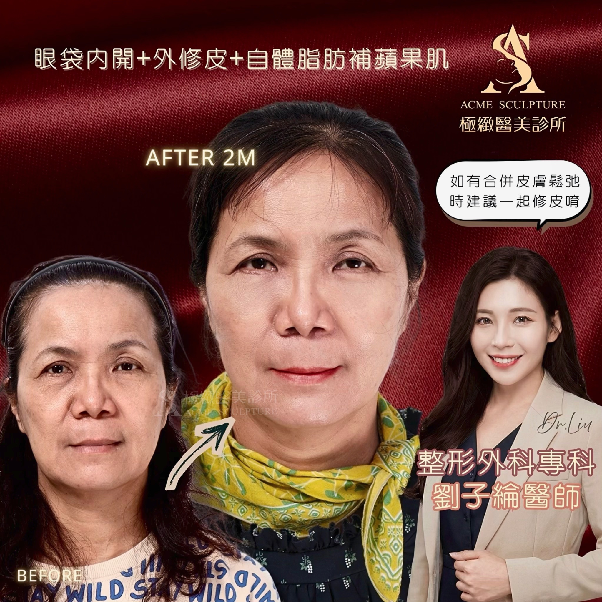 內開眼袋與蘋果肌補脂術前術後-劉子綸醫師案例