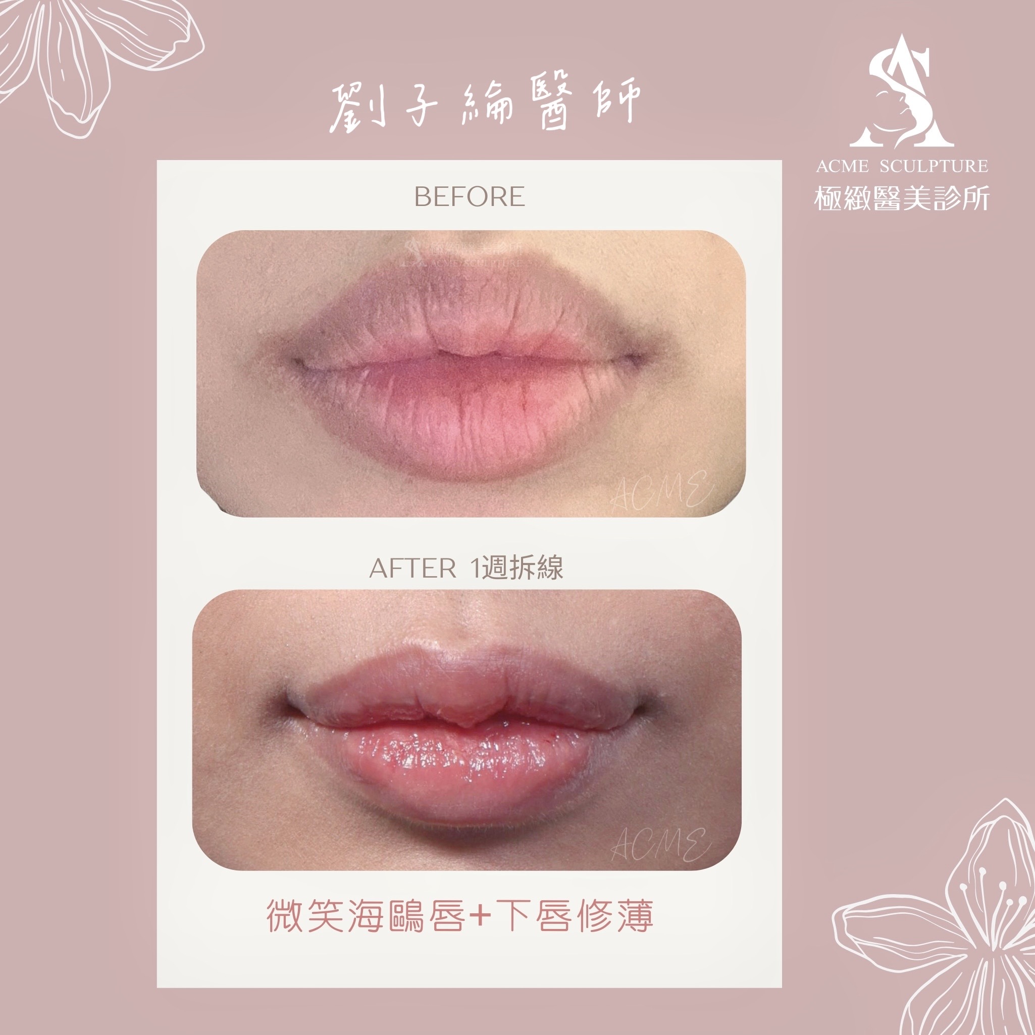 微笑唇 海鷗唇 M型唇 劉子綸醫師 