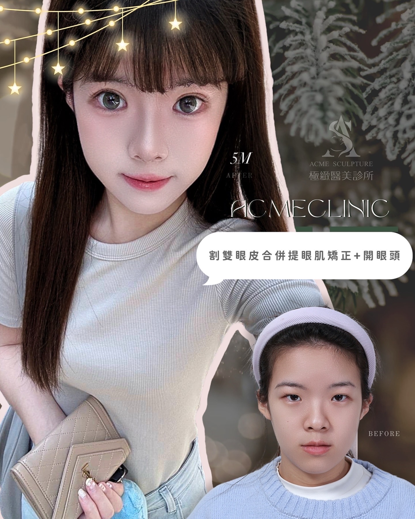 割雙眼皮提眼肌矯正+開眼頭 術前術後