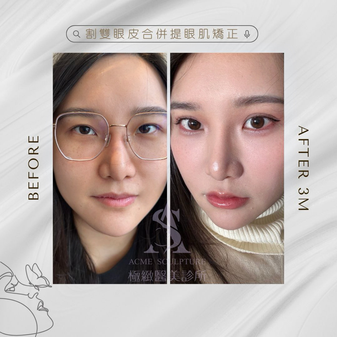 重修雙眼皮提眼肌矯正 術前術後