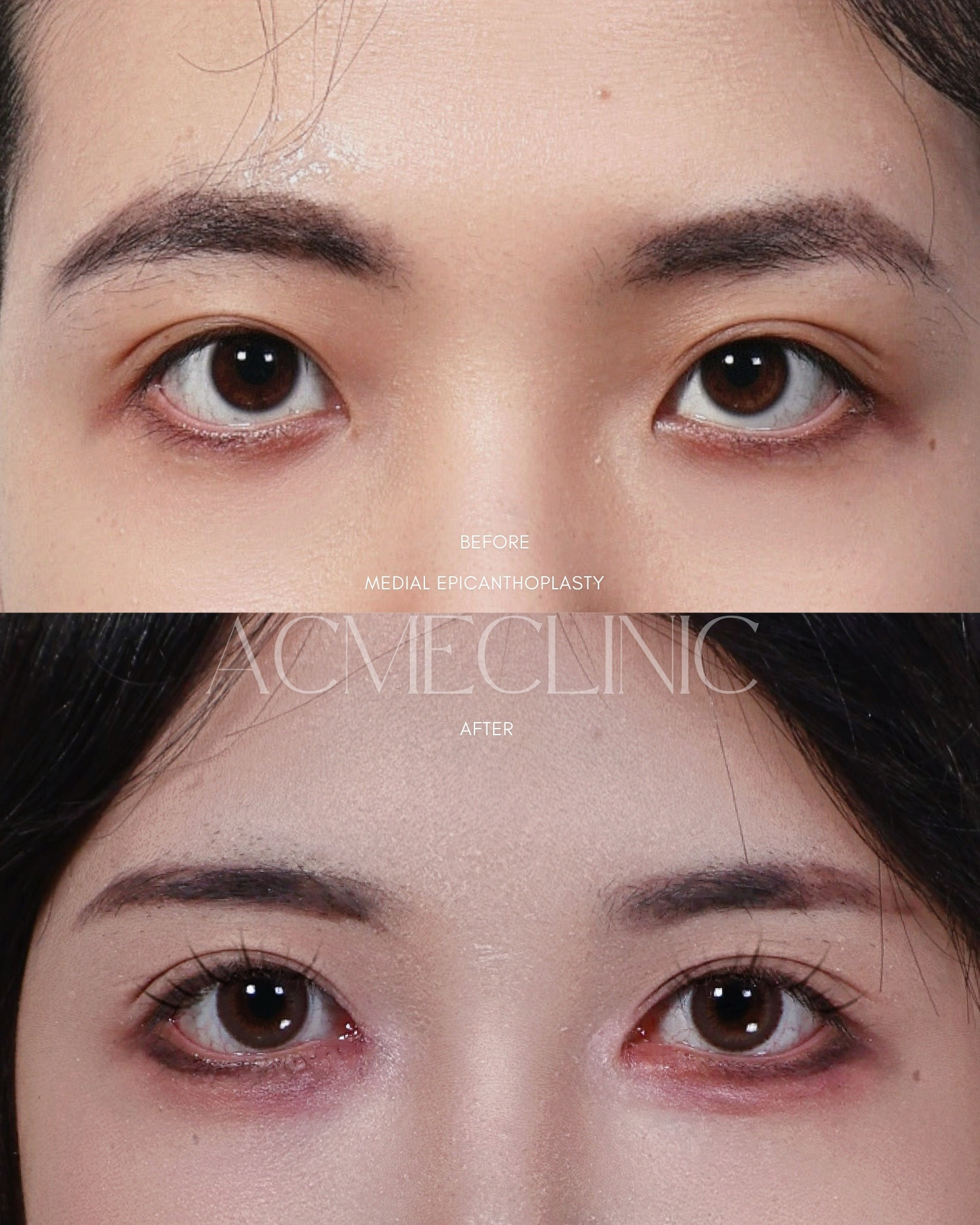 羅國銓醫師 隱痕開眼頭 術前術後 