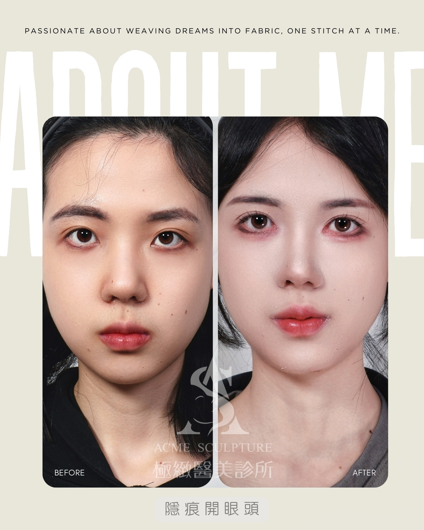 羅國銓醫師 隱痕開眼頭 before anf after