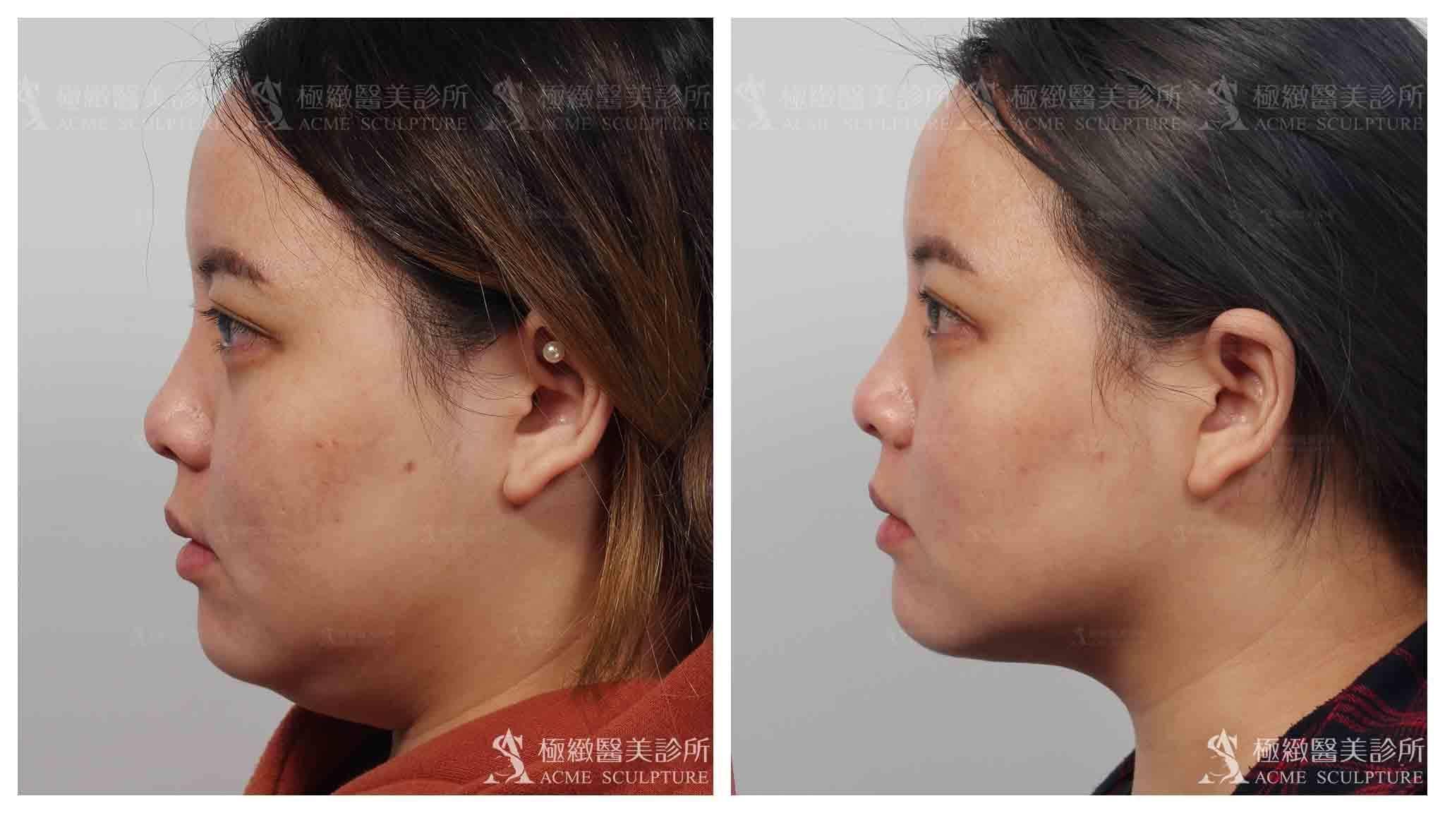 威塑抽脂体雕(vaser)