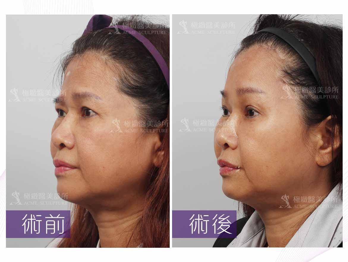 微創拉提 內視鏡提眉 極緻醫美診所 手術項目