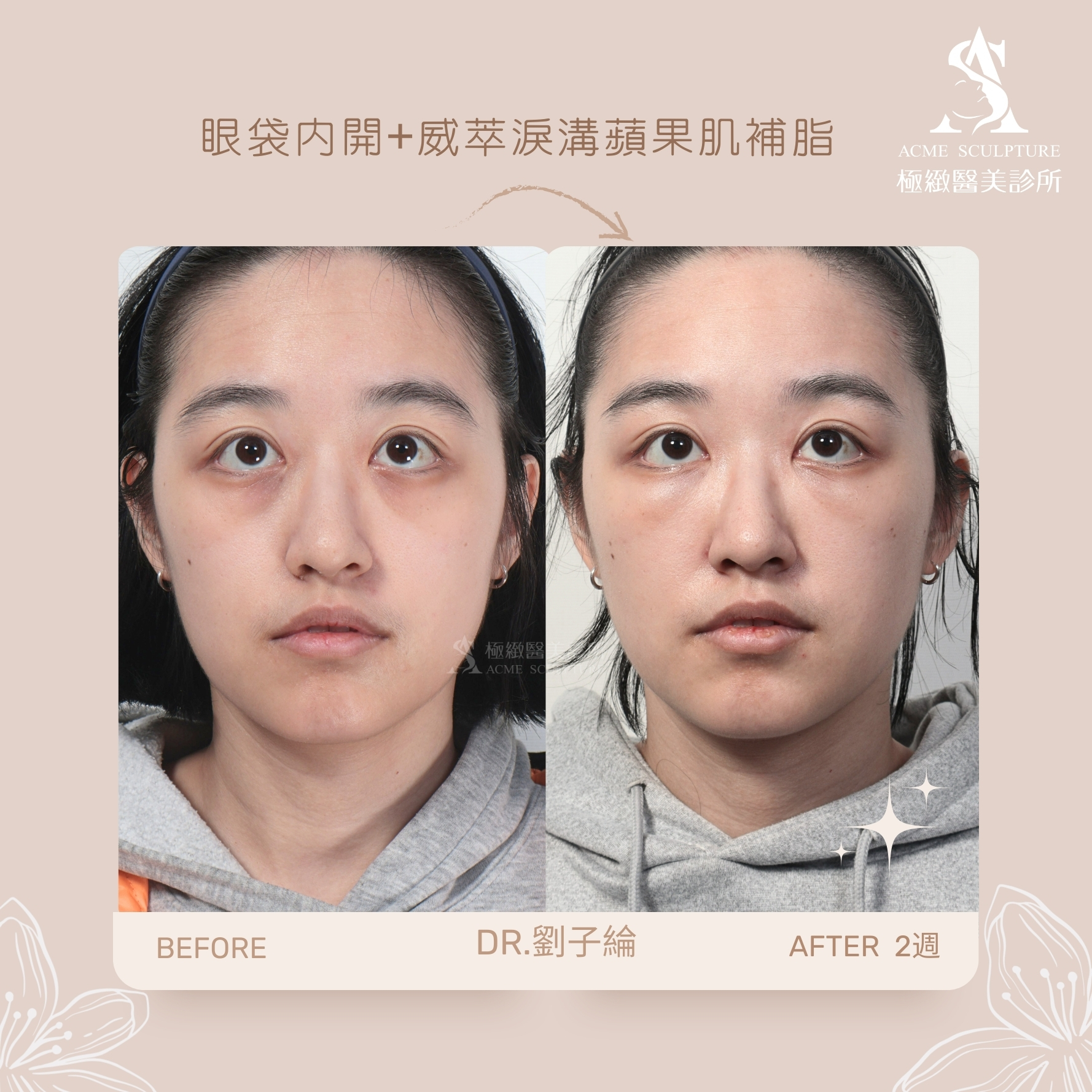 眼袋 淚溝 疲倦感 劉子綸醫師 