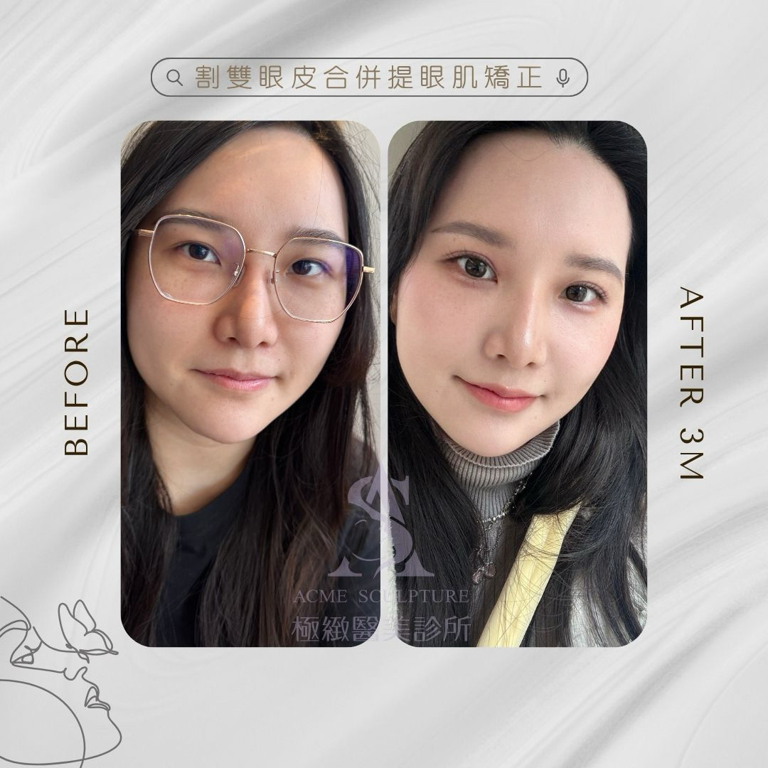 重修雙眼皮提眼肌矯正 術前術後2