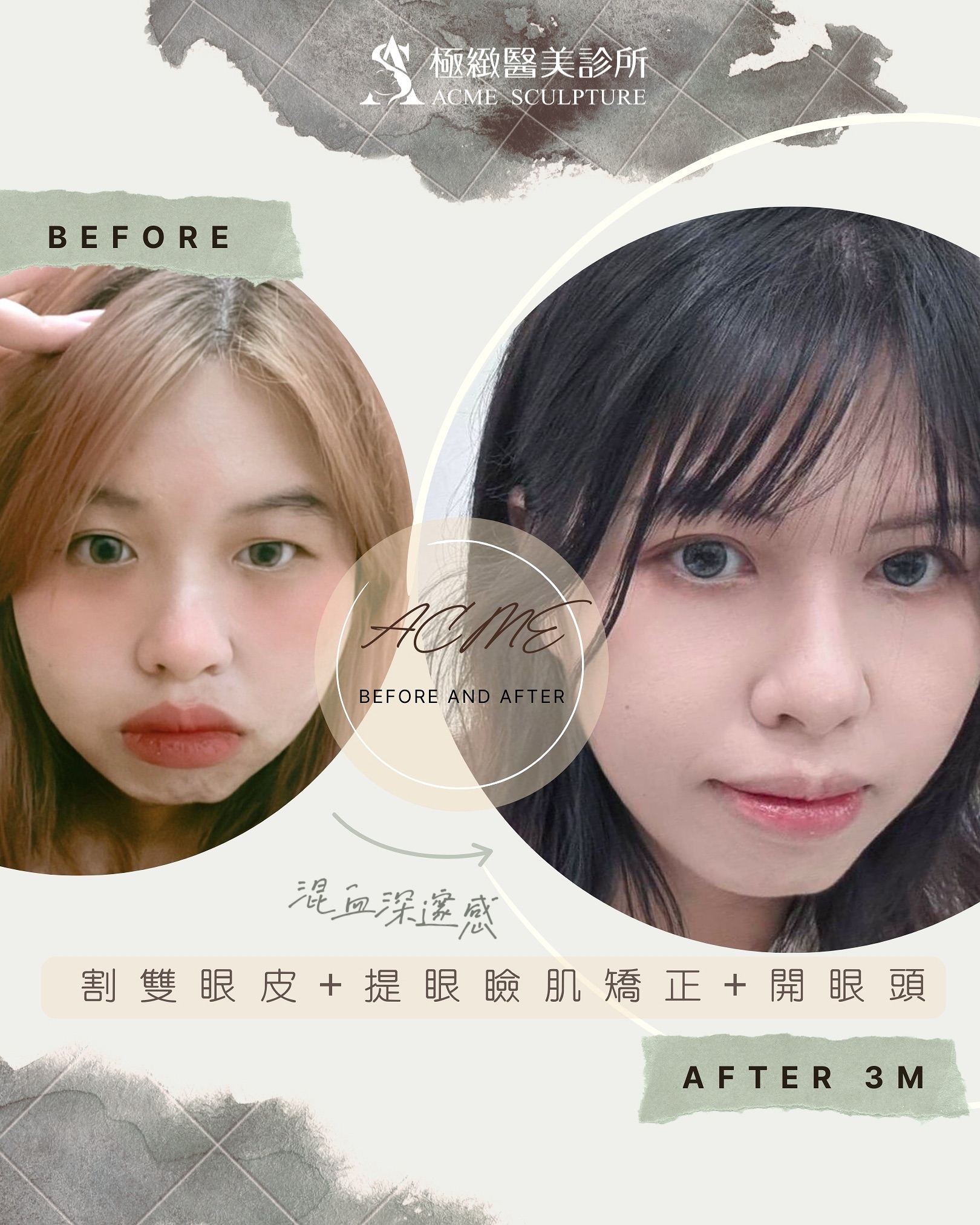 提眼肌矯正 大小眼 術前術後