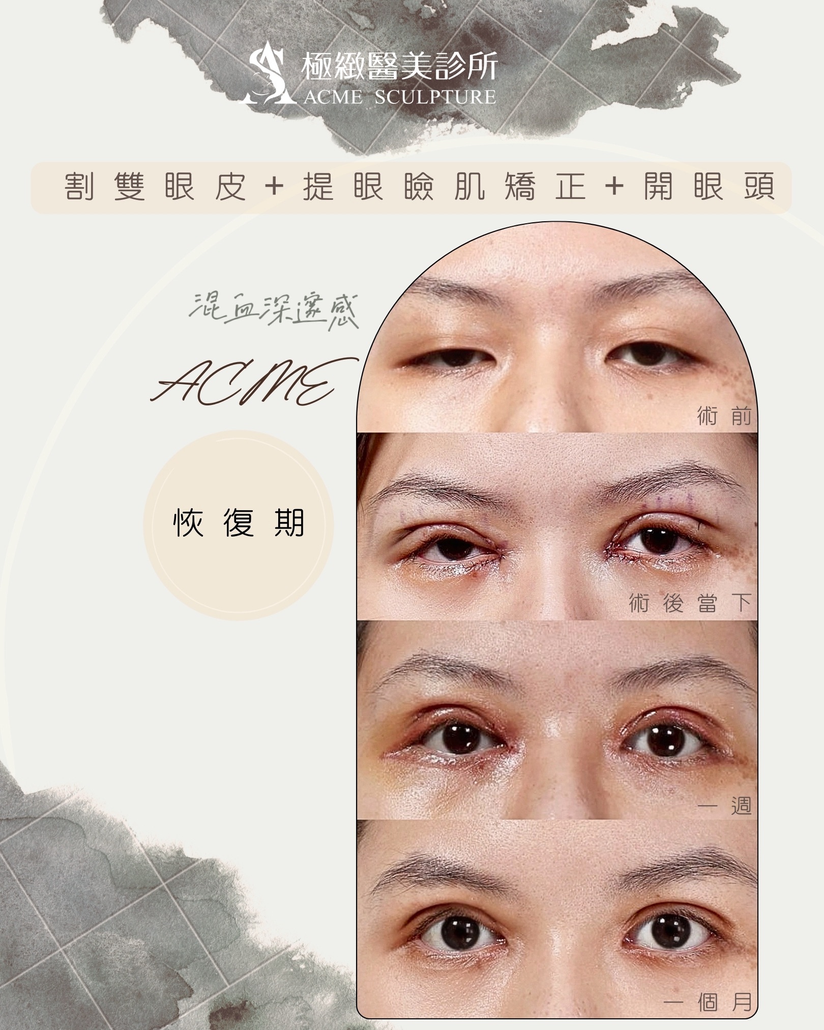 割雙眼皮提眼肌矯正術前術後