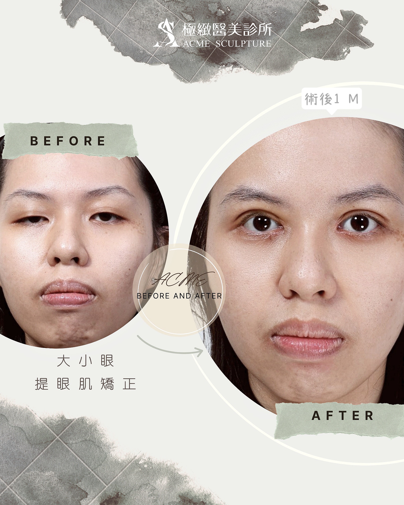 大小眼提眼肌矯正術前術後