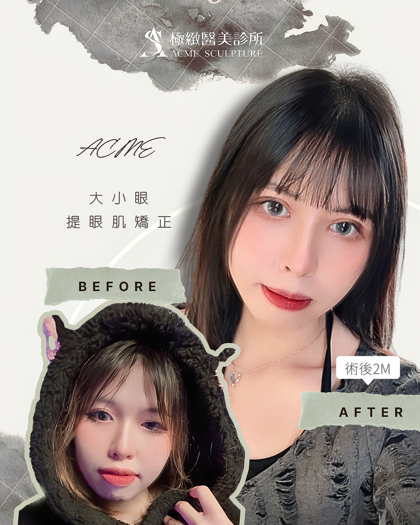 混血雙眼皮 術前術後