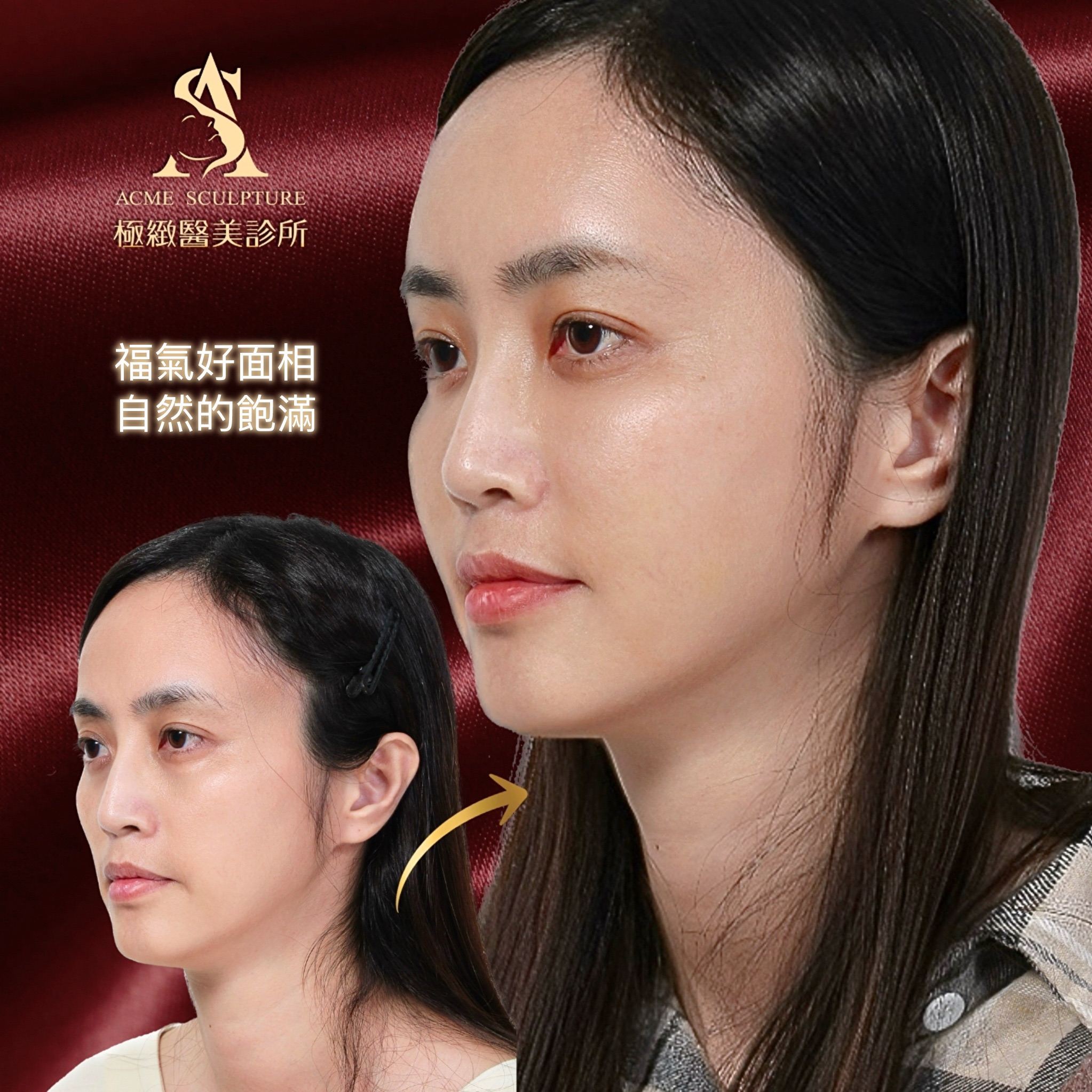 整形外科手術成果分享-劉子綸醫師