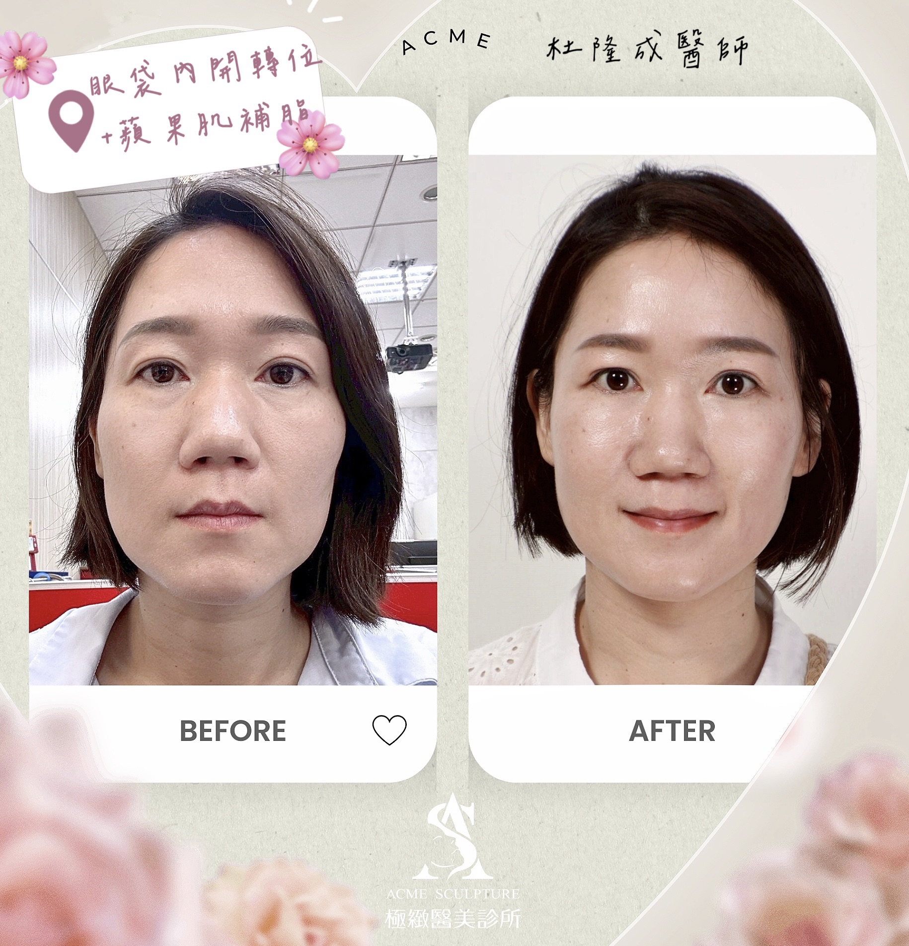 內開眼袋轉位固定+蘋果肌補脂 杜隆成醫師 台北眼袋