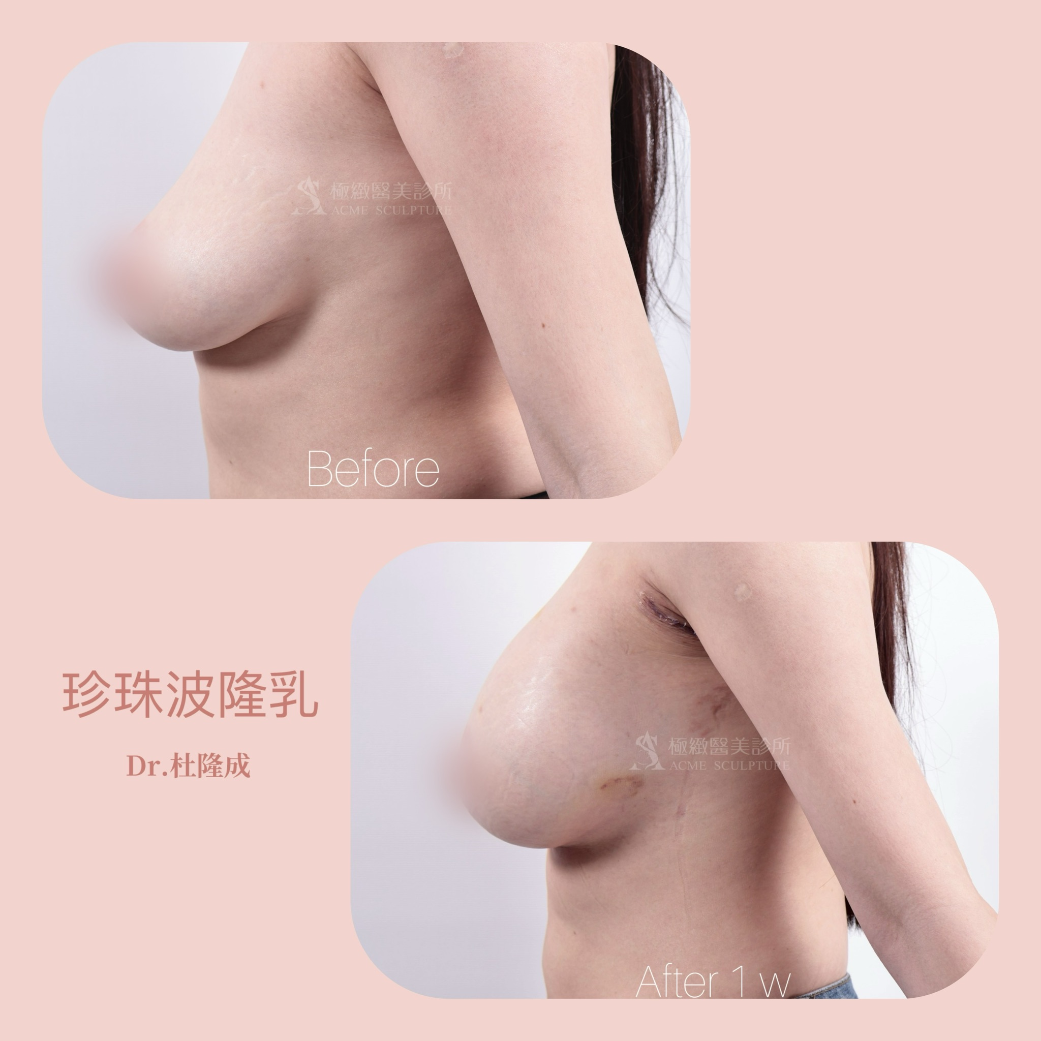 珍珠波 盈波 杜隆成醫師 假體隆乳 女王波 魔滴二代隆乳