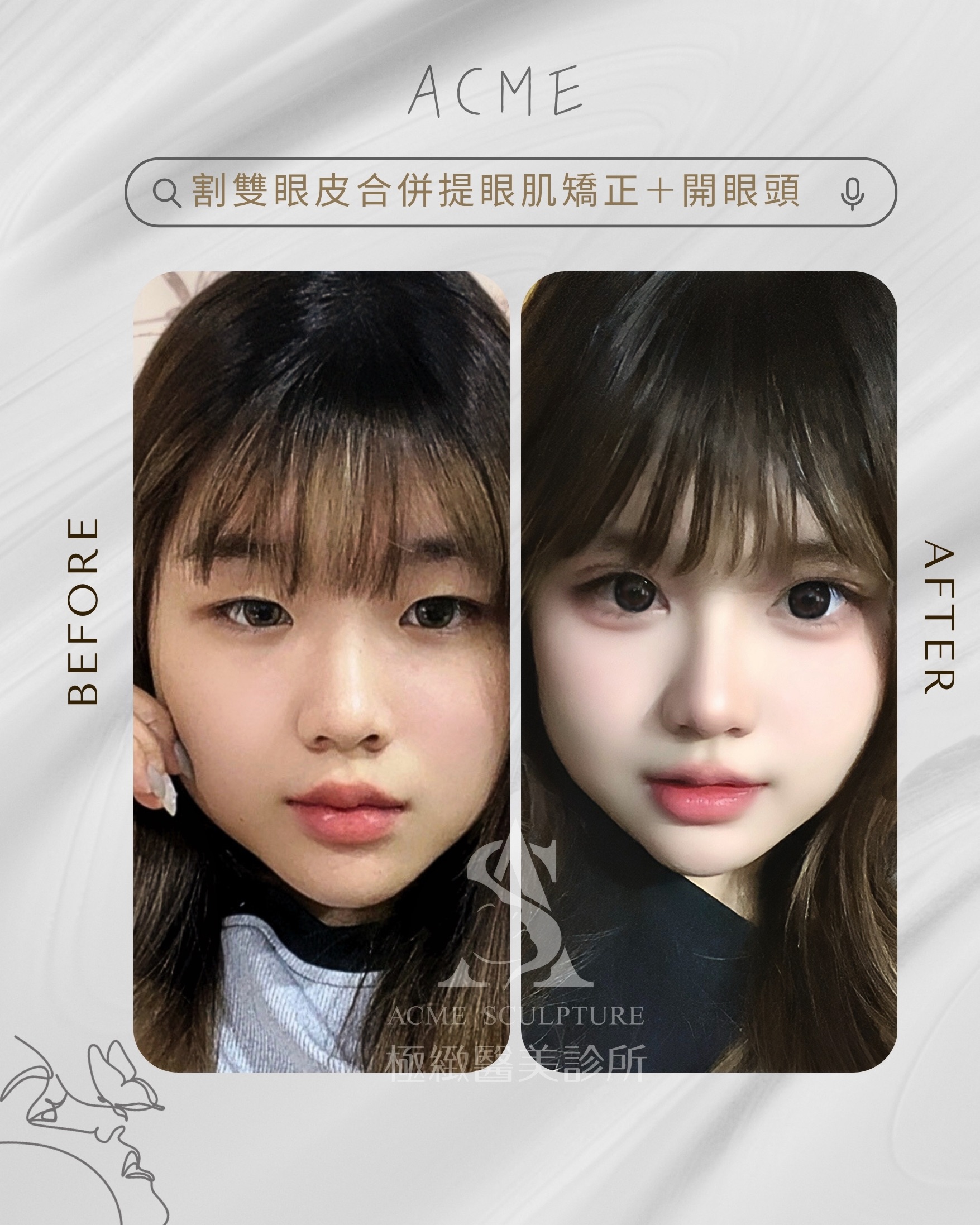 幼態感雙眼皮 眼綜合術前術後