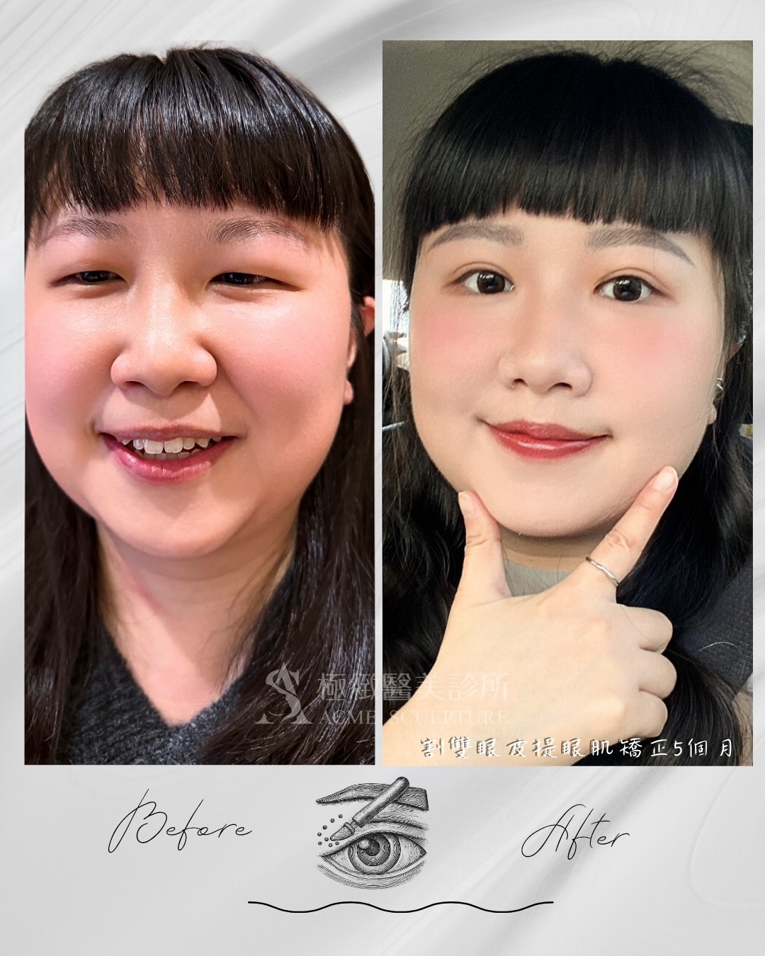 泡泡眼 術前術後