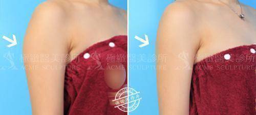 手臂抽脂案例2-2